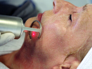 Le laser CO2 chez Claris Clinic