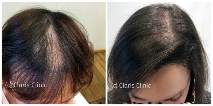 Avant/Après traitement PRP pour les cheveux