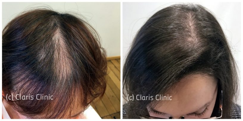 Before/After PRP treatment for hair