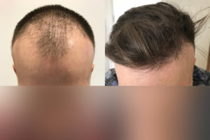 FUE Transplant Results