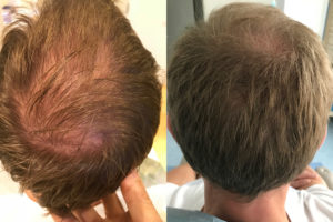 FUE Transplant Results