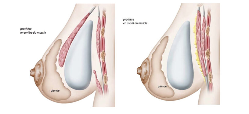 positionnement des implants