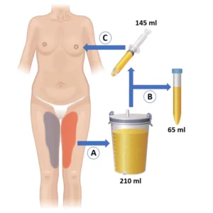 lipofilling