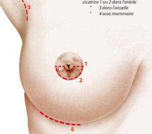 Les voies d'abord de l'augmentation mammaire