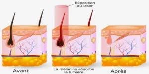 Le fonctionnement de l'épilation laser