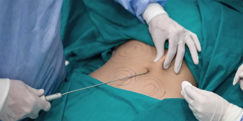 Liposuccion abdominale