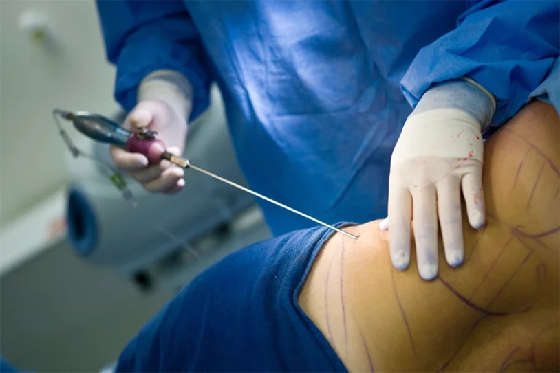 Liposuccion