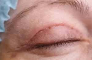 blepharoplasty scar