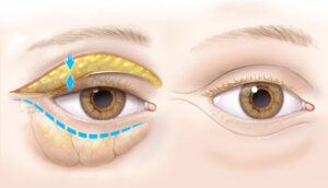 Cicatrices de blepharoplastie