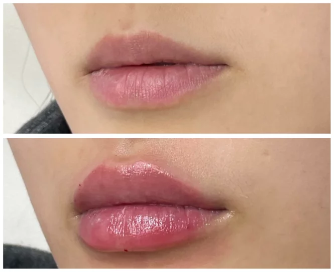 Before after lips