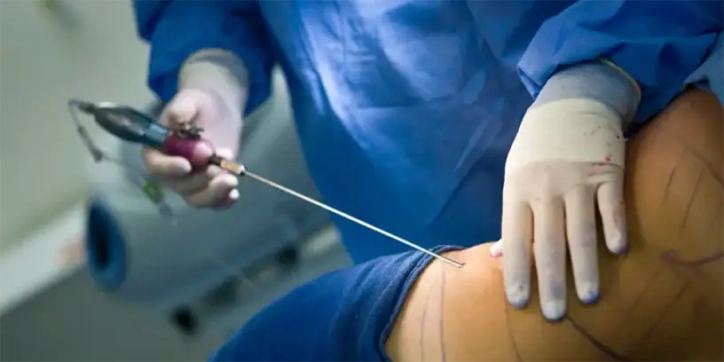 Liposuccion en cours, technique de remodelage corporel.