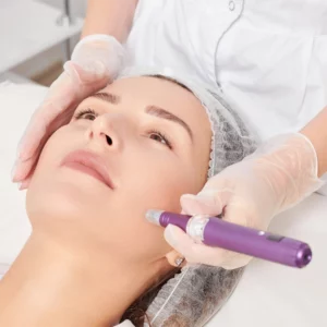 microneedling