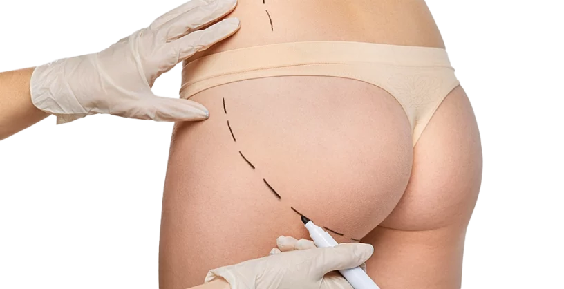 buttock implant