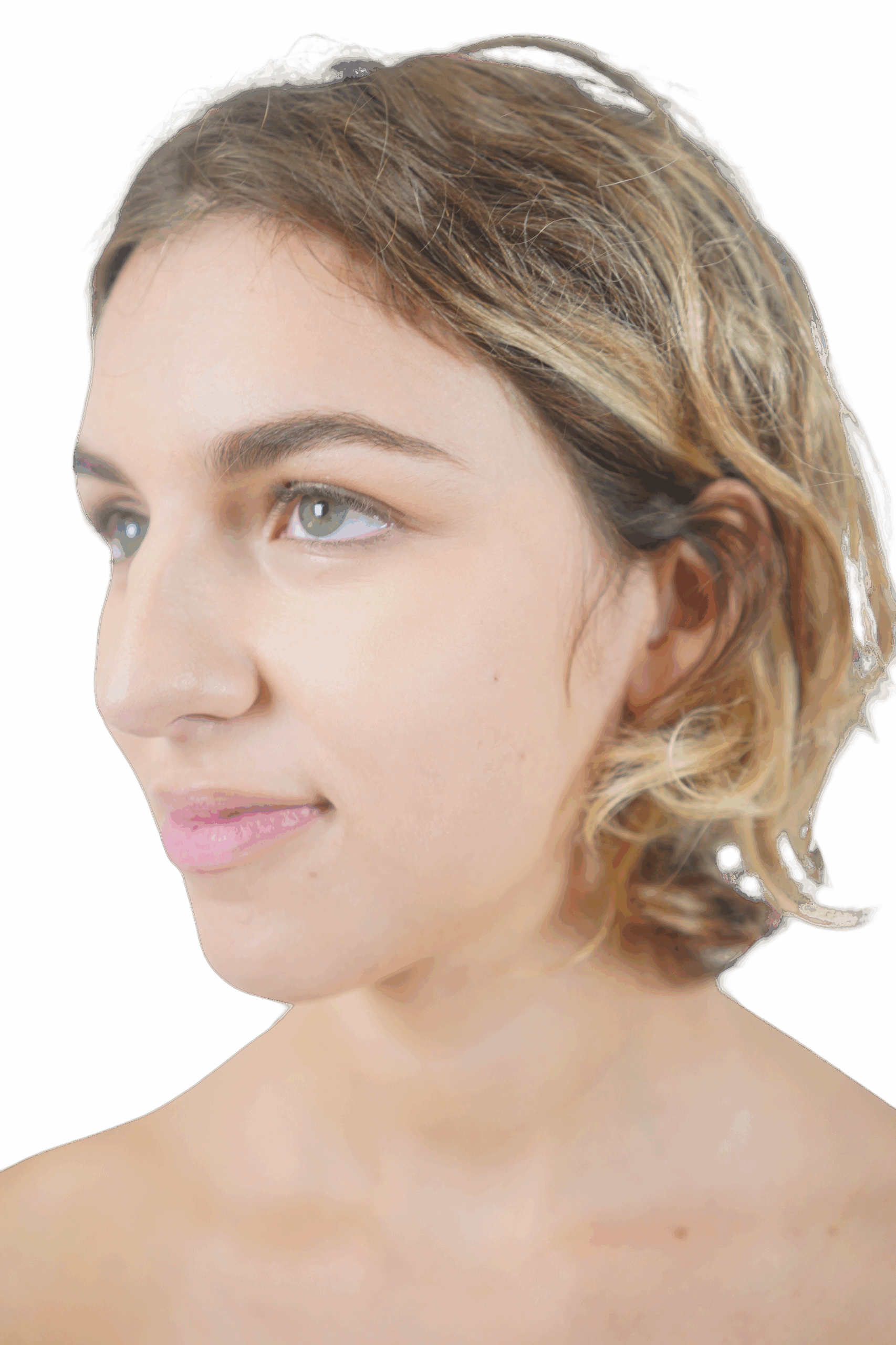 Le résultat du traitement Profhilo® - Claris Clinic