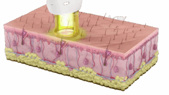 Epilation laser