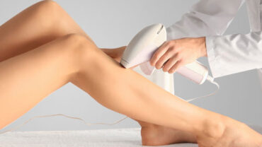 Laser hair removal