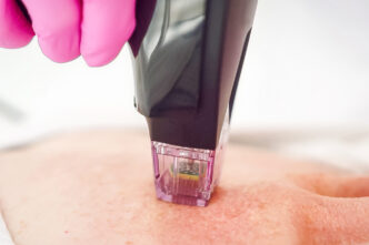 Pièce à main de radiofréquence appliquée sur la peau du visage chez Claris Clinic