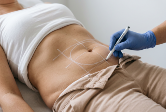Mesures de la surface à traiter : cryolipolyse.