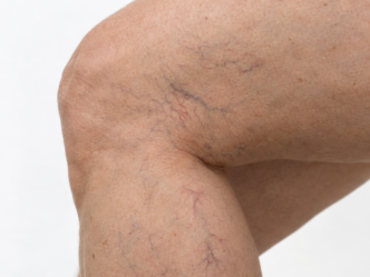 Varicosités sur la jambe traitées au laser vasculaire chez Claris Clinic