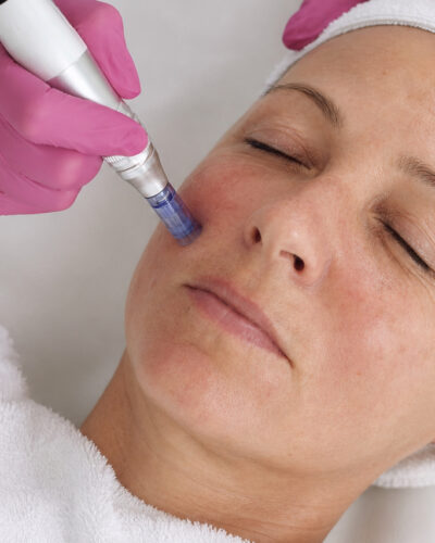 Microneedling chez Claris Clinic