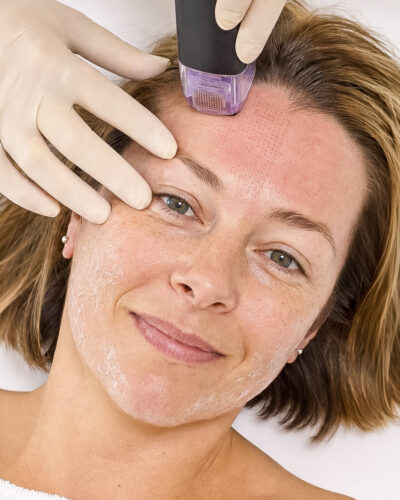 Morpheus8 chez Claris Clinic
