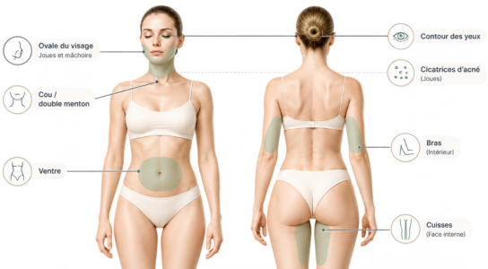 Schéma des zones du visage et du corps traitées au Morpheus8